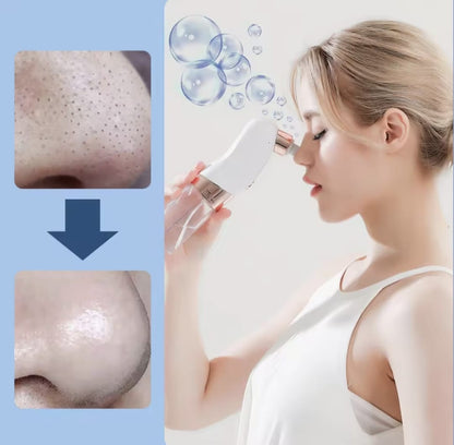 Blackhead Removal